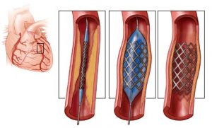 endovaskulyarnie-stentirovanie-koronarnih-arteriy